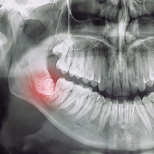 chirurgiczne usuwanie ósemek zatrzymanych Wrocław