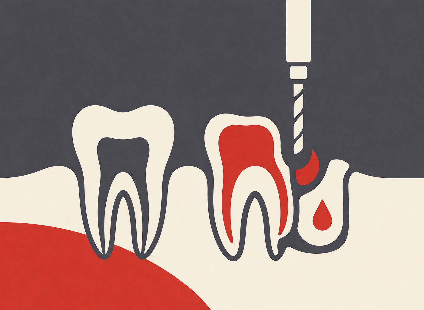 Resekcja wierzchołka korzenia